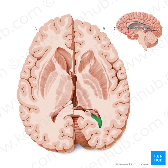 Corno occipital do ventrículo lateral (Cornu occipitale ventriculi lateralis); Imagem: Paul Kim