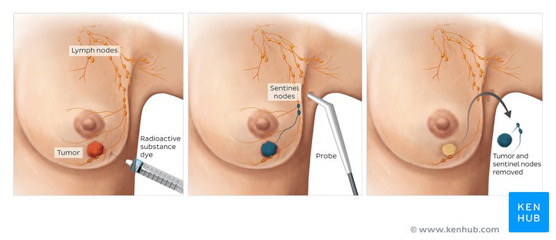 Breast Sentinel Node Biopsy