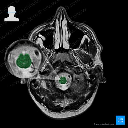 Medulla oblongata; Image: 