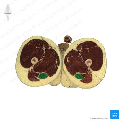 Musculus semitendinosus (Halbsehnenmuskel); Bild: National Library of Medicine