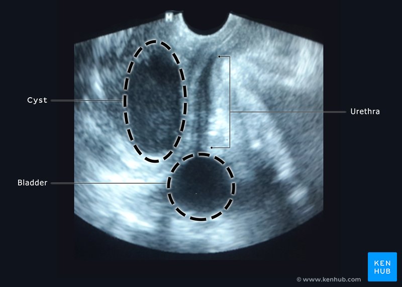 Perineal ultrasound showing a Müllerian cyst