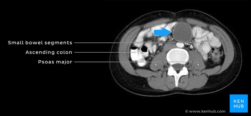Axial CT showing urachal cyst