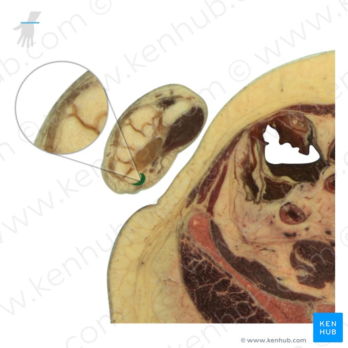 Tendo musculi abductoris digiti minimi (Sehne des Kleinfingerspreizers); Bild: National Library of Medicine