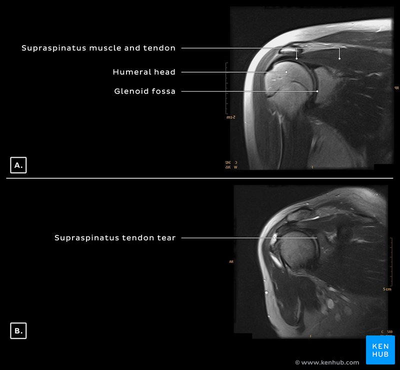 Supraspinatus muscle and tendon - T2 MRI