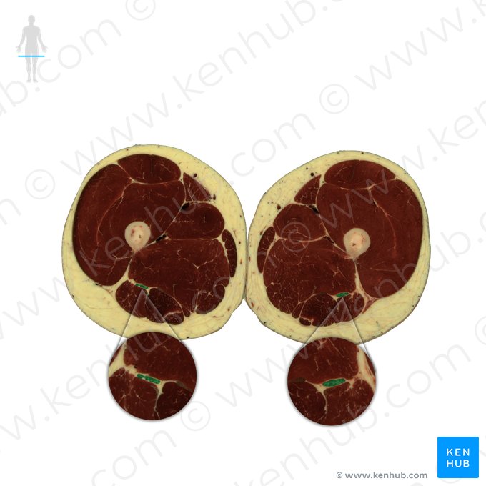 Nervo ciático (Nervus ischiadicus); Imagem: National Library of Medicine