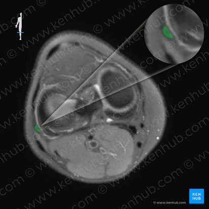 Ligamentum collaterale fibulare genus (Äußeres Kollateralband des Knies); Bild: 