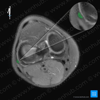 Ligamentum collaterale fibulare genus (Äußeres Kollateralband des Kniegelenks); Bild: 