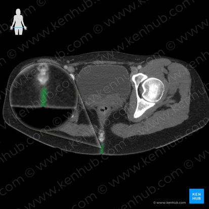 Intergluteal cleft (Crena interglutealis); Image: 