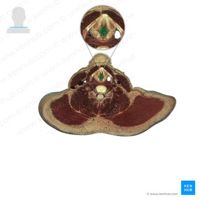Laryngopharynx (Pars laryngea pharyngis); Image: National Library of Medicine