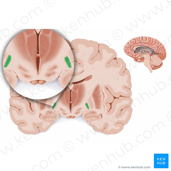 Globo pálido medial (Globus pallidus medialis); Imagem: Paul Kim