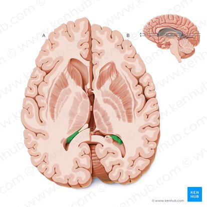 Plexo coroideo del ventrículo lateral (Plexus choroideus ventriculi lateralis); Imagen: Paul Kim