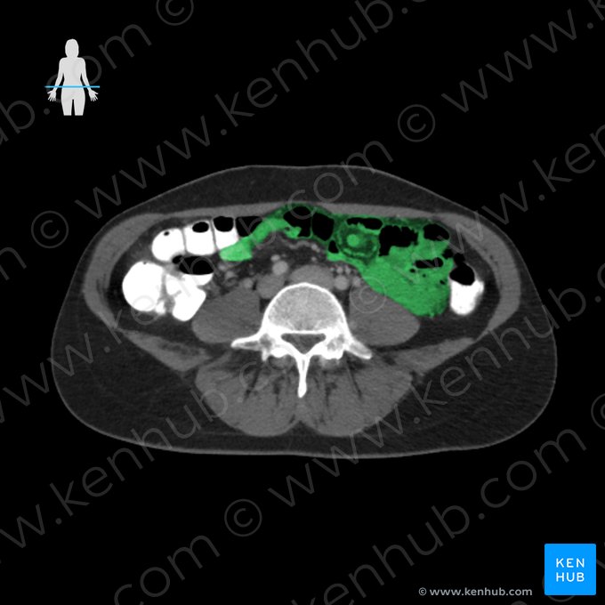 Ileum (Krummdarm); Bild: 