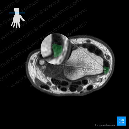 Tendon of abductor pollicis longus muscle (Tendo musculi abductoris pollicis longi); Image: 