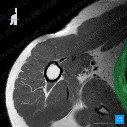 Serratus anterior muscle (Musculus serratus anterior); Image: 