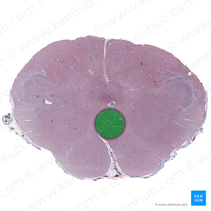 Decusación del lemnisco medial (Decussatio lemniscorum medialium); Imagen: 