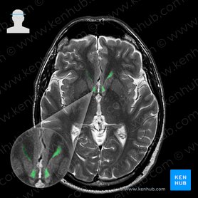 Asta frontal del ventrículo lateral (Cornu frontale ventriculi lateralis); Imagen: 
