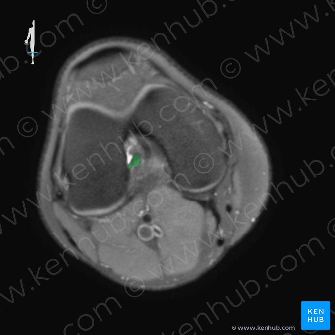 Ligamento cruzado anterior (Ligamentum cruciatum anterius); Imagem: 