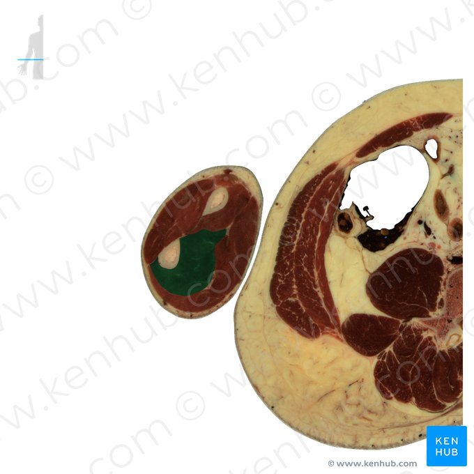 Músculo flexor profundo dos dedos (Musculus flexor digitorum profundus); Imagem: National Library of Medicine