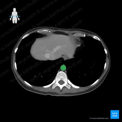 Aorta descendente torácica (Aorta thoracica descendens); Imagem: 