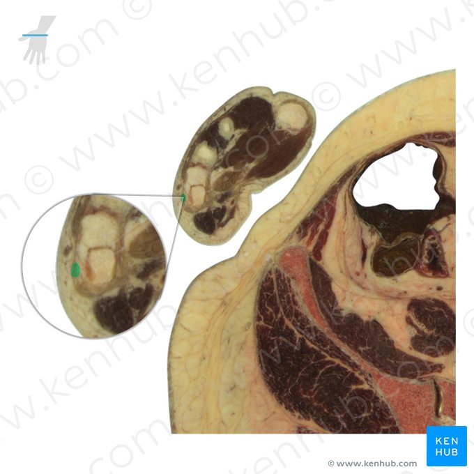 Tendon of extensor digiti minimi muscle (Tendo musculi extensoris digiti minimi); Image: National Library of Medicine