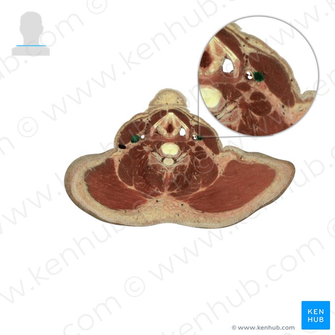 Internal jugular vein (Vena jugularis interna); Image: National Library of Medicine