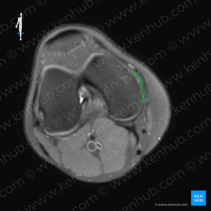 Ligamento colateral tibial de la articulación de la rodilla (Ligamentum collaterale tibiale genus); Imagen: 