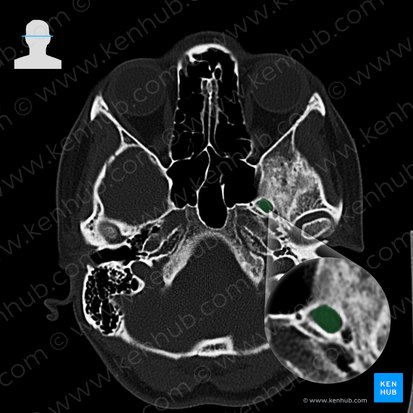 Foramen oval del hueso esfenoides (Foramen ovale); Imagen: 