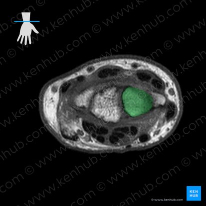 Scaphoid bone (Os scaphoideum); Image: 