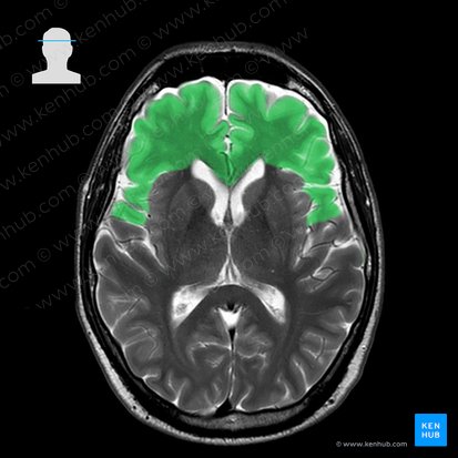 Frontal lobe (Lobus frontalis); Image: 