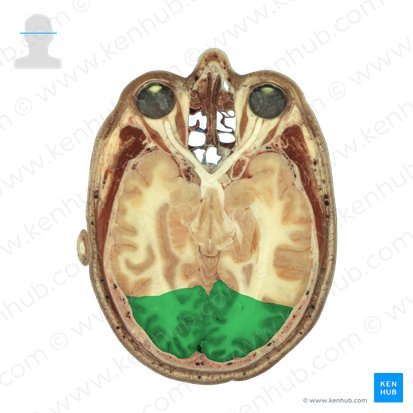 Lobus occipitalis (Hinterhauptlappen); Bild: National Library of Medicine