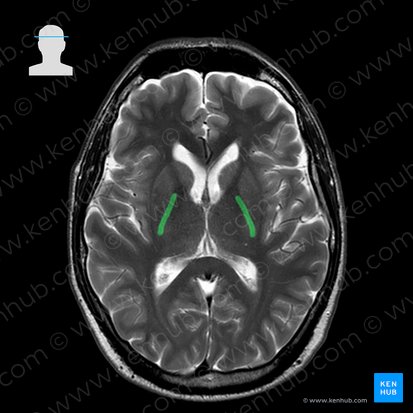 Posterior limb of internal capsule (Crus posterius capsulae internae); Image: 