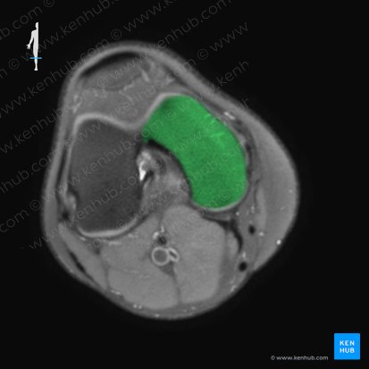 Cóndilo medial del fémur (Condylus medialis femoris); Imagen: 