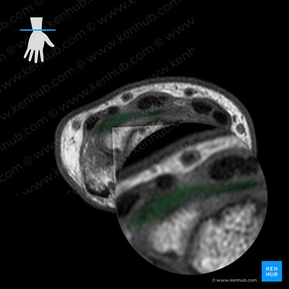 Dorsal ulnocarpal ligament (Ligamentum ulnocarpeum dorsale); Image: 