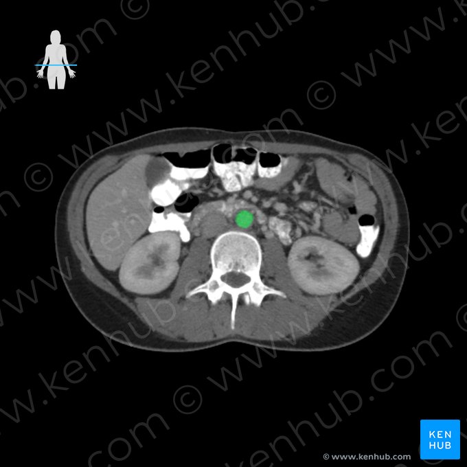 Aorta abdominal (Aorta abdominalis); Imagem: 