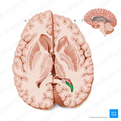 Occipital horn of lateral ventricle (Cornu occipitale ventriculi lateralis); Image: Paul Kim