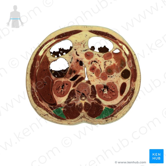 Músculo iliocostal lombar (Musculus iliocostalis lumborum); Imagem: National Library of Medicine