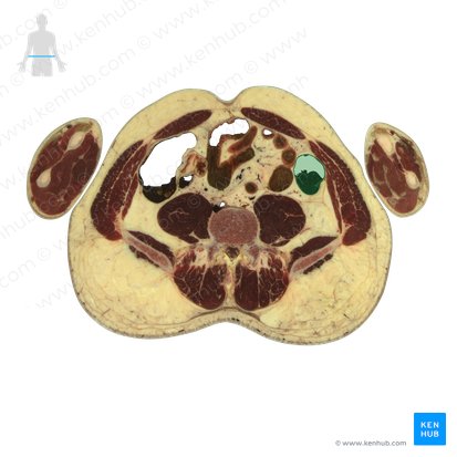 Descending colon (Colon descendens); Image: National Library of Medicine