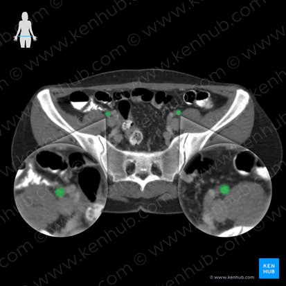 External iliac artery (Arteria iliaca externa); Image: 