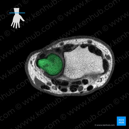 Ulna; Image: 