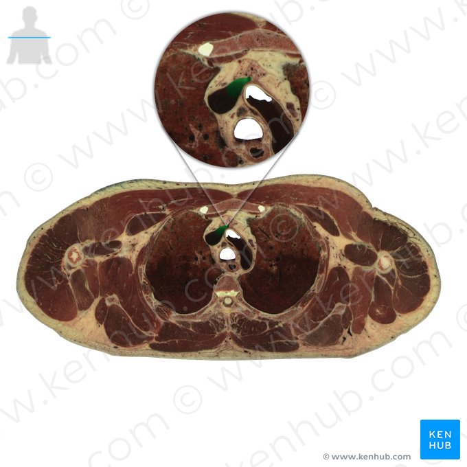 Vena brachiocephalica sinistra (Linke Oberarm-Kopf-Vene); Bild: National Library of Medicine