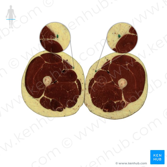 Veia safena magna (Vena saphena magna); Imagem: National Library of Medicine