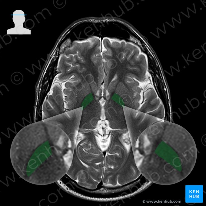 Globo pálido (Globus pallidus); Imagen: 