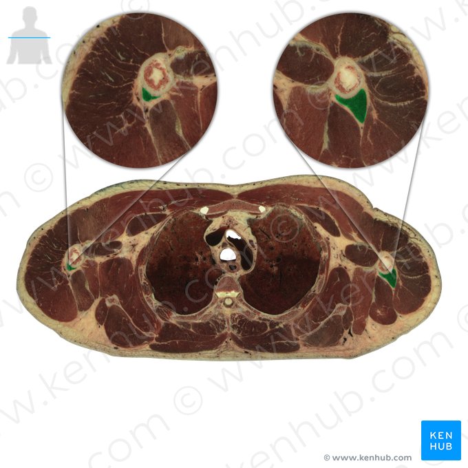 Caput laterale musculi tricipitis brachii (Seitlicher Kopf des dreiköpfigen Oberarmmuskels); Bild: National Library of Medicine