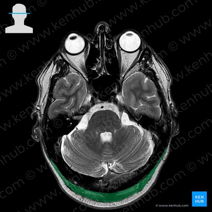 Occipitalis muscle (Musculus occipitalis); Image: 