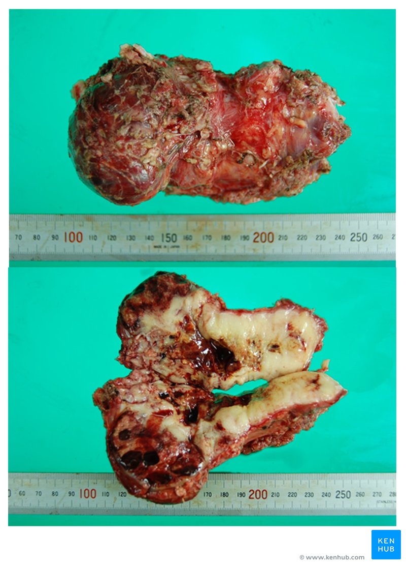 Malignant spindle cell tumor - macroscopy