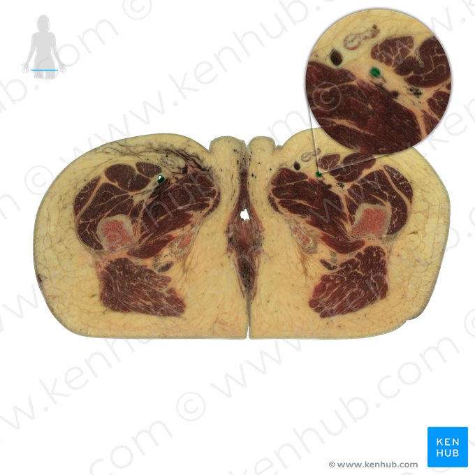 Arteria femoralis (Oberschenkelarterie); Bild: National Library of Medicine