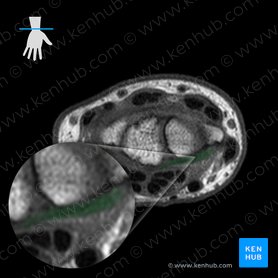 Palmar radiocarpal ligament (Ligamentum radiocarpeum palmare); Image: 