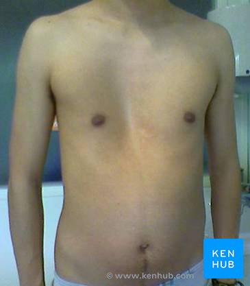 Pectus excavatum