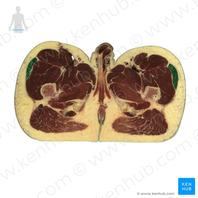 Musculus tensor fasciae latae (Schenkelbindenspanner); Bild: National Library of Medicine