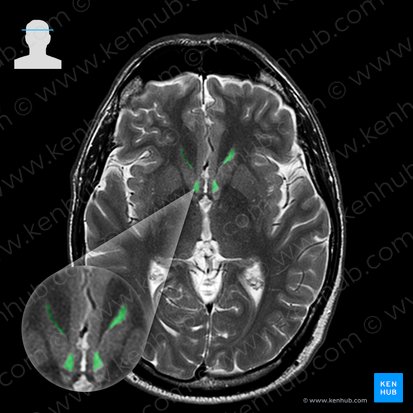 Frontal horn of lateral ventricle (Cornu frontale ventriculi lateralis); Image: 